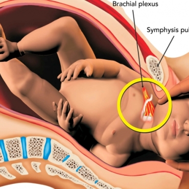 Birth Injuries: What is Erb’s Palsy, and How is it Avoided?