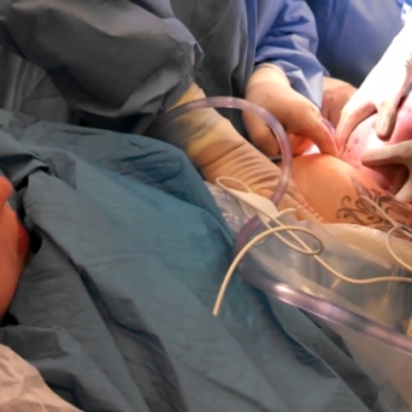 C-Section Birth for a Breech Baby