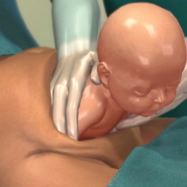 Cesarean Birth (C-section) Procedure