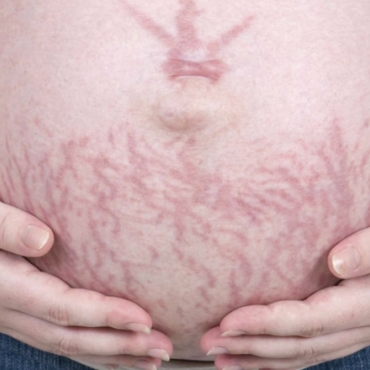 How Can I Get Rid of Pregnancy Stretch Marks?