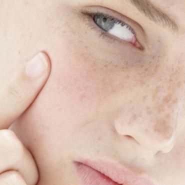 How to Clear up Acne While Pregnant 