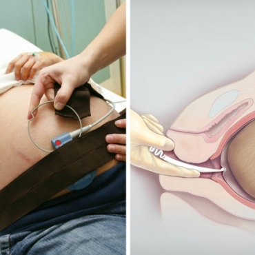 How to Induce Labor Medically?