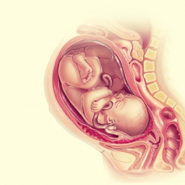 Pregnancy Complications: Placenta Accreta