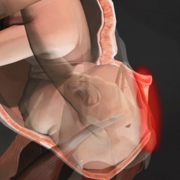 The Ring of Fire When Giving Birth