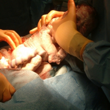 What You Need to Know About Cesarean Birth